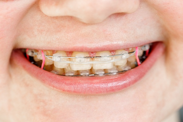 How To Keep Clear Braces From Yellowing