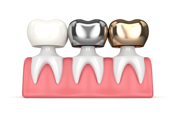 Common Signs That You May Need Dental Fillings