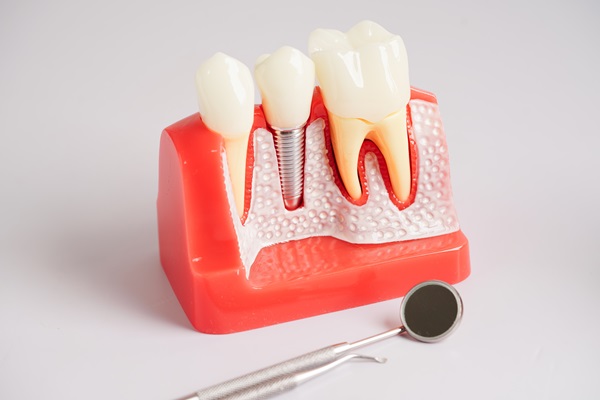 How Dental Implants Are Used With Bridges