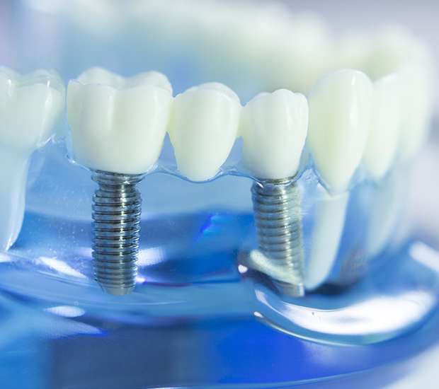 St Petersburg Dental Implants