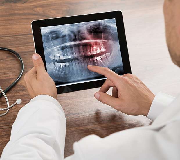 St Petersburg Types of Dental Root Fractures